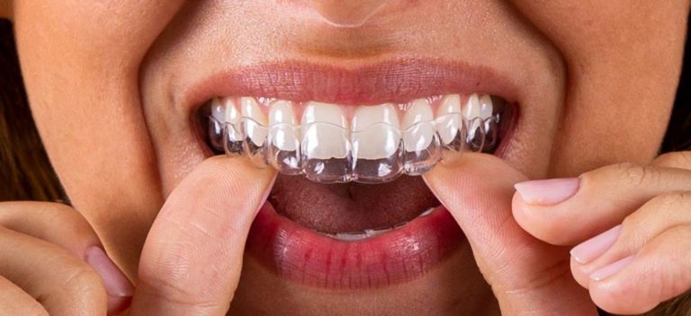beneficios de la ortodoncia invisible
