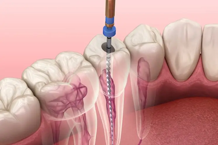 endodoncia unirradicular