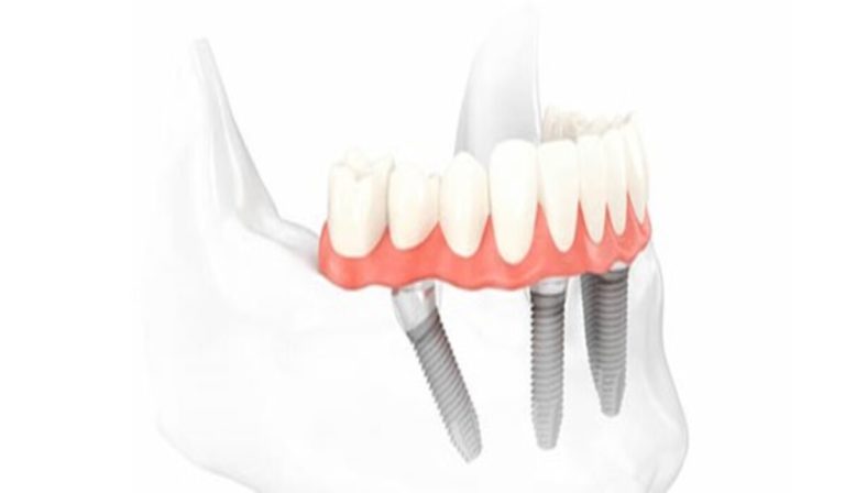 implantes dentales de carga inmediata