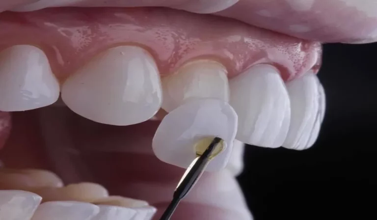 Diferencias entre carillas y microcarillas dentales