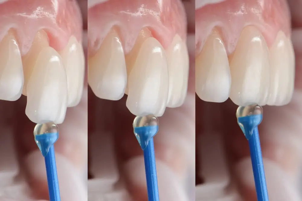 Proceso de colocación de carillas dentales: Guía completa para una sonrisa perfecta