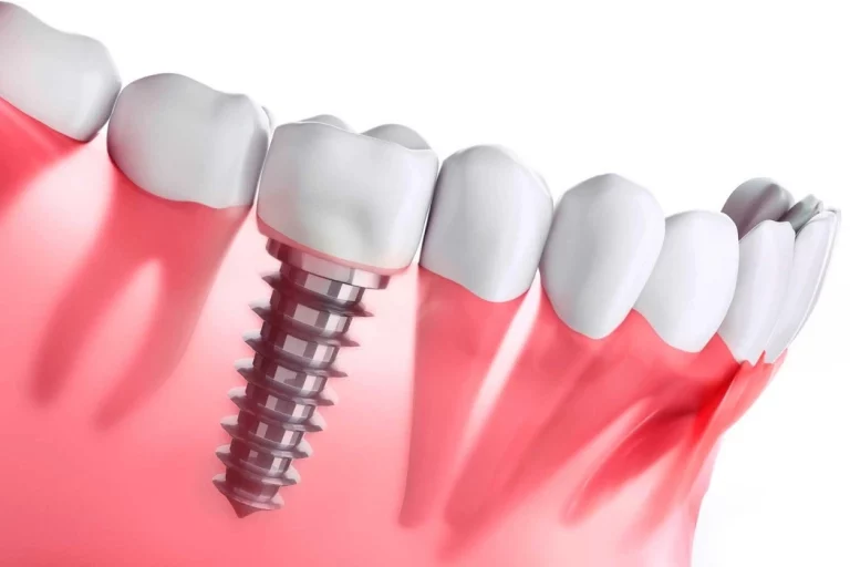 implantes dentales en madrid
