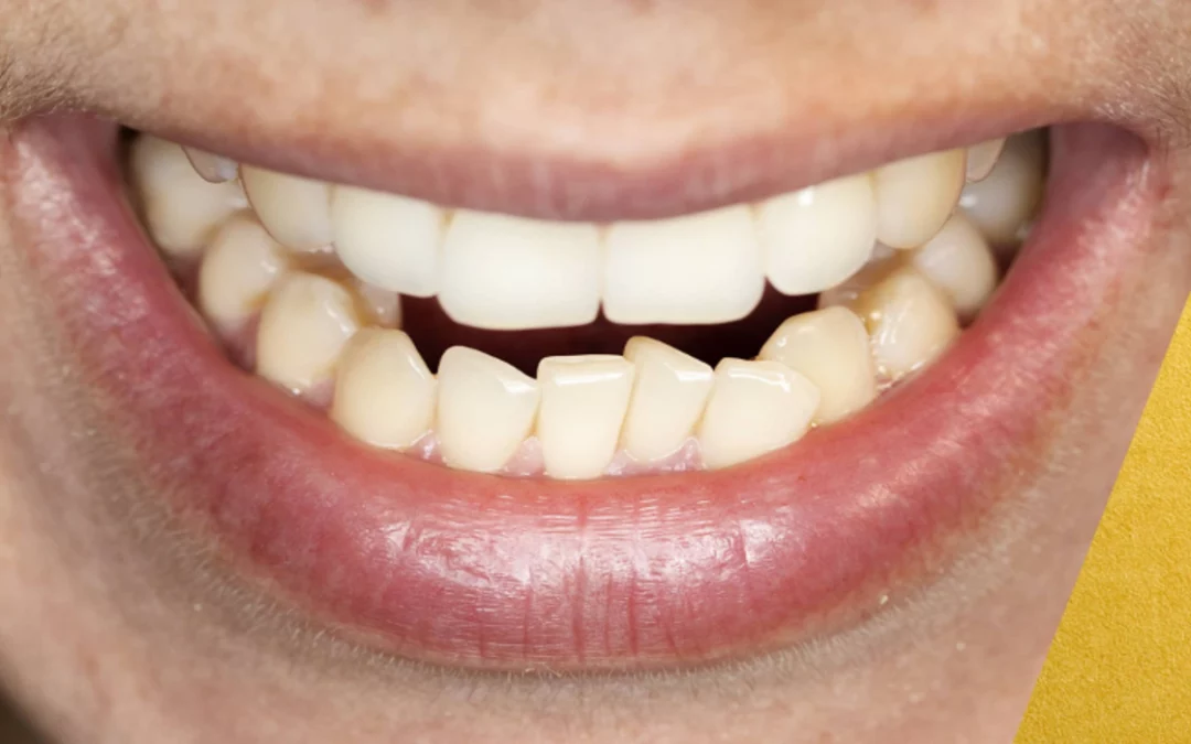 apiñamiento dental causas, consecuencias y tratamientos