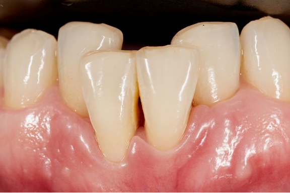 consecuencias del apiñamiento dental