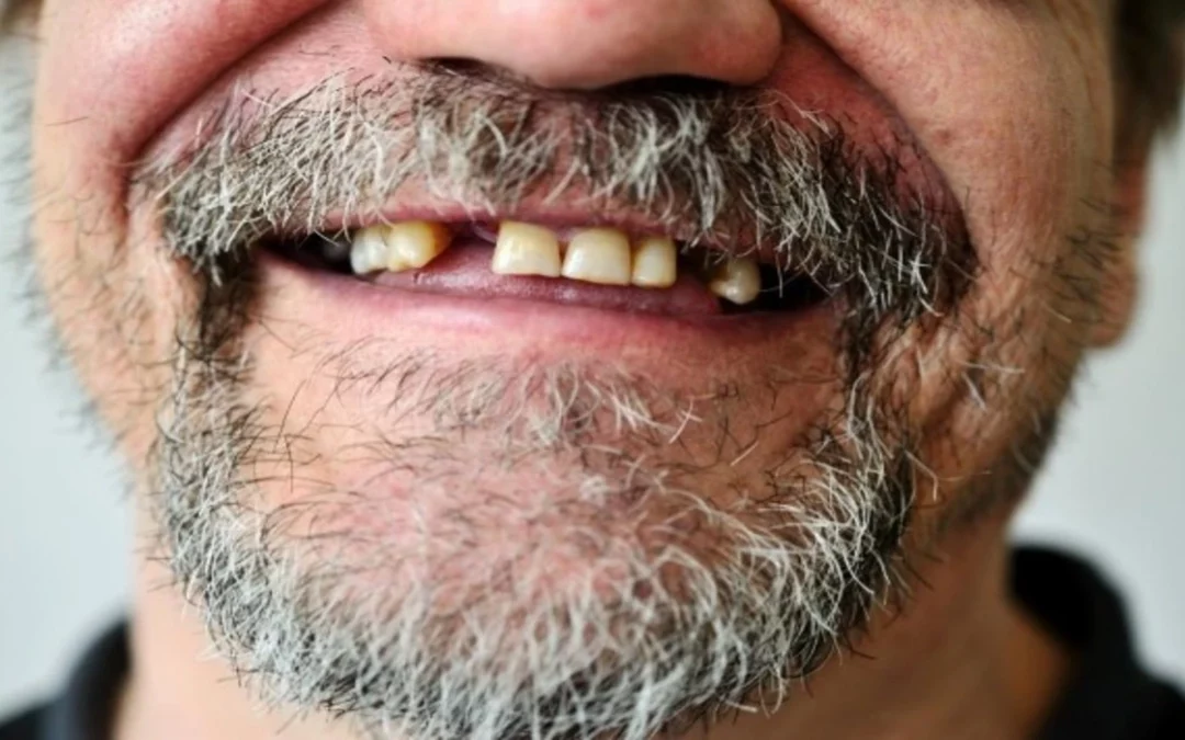 Consecuencias de la falta de dientes: impacto en la salud bucodental