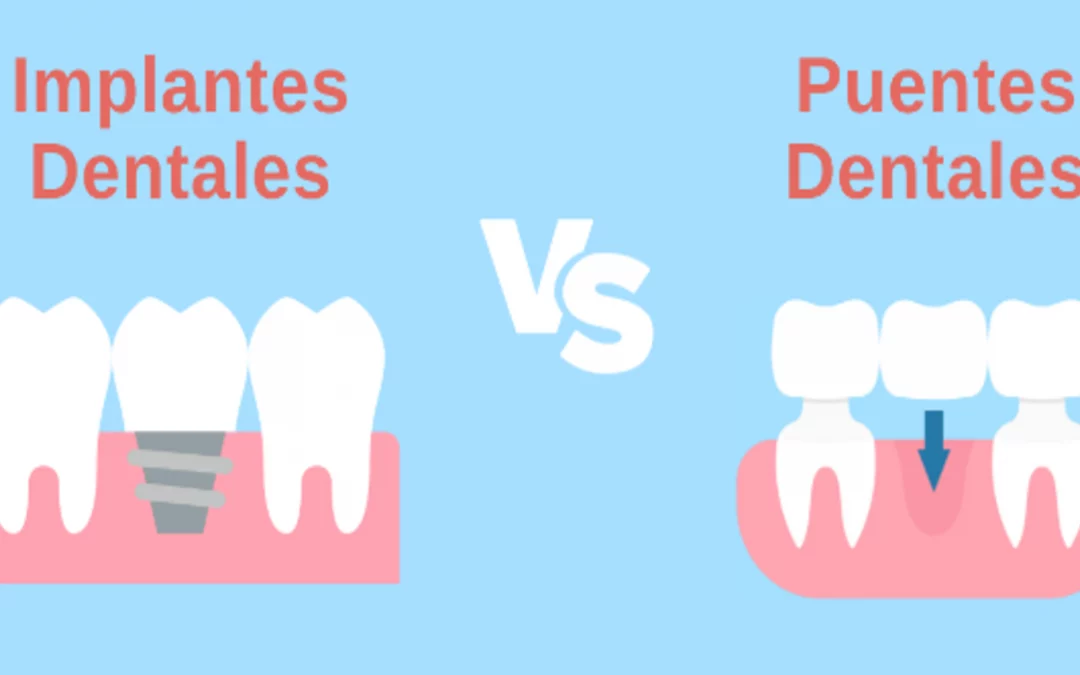 Implantes o puentes dentales: ¿Cuál es la mejor opción para ti?