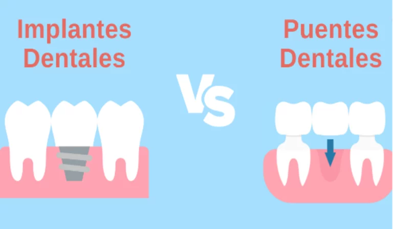 Implantes o puentes dentales