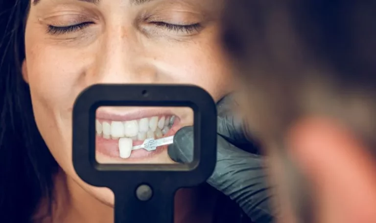 cuidado de carillas dentales