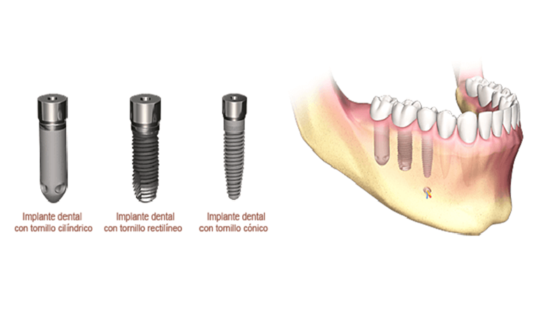 cuales son los tipos de implantes dentales