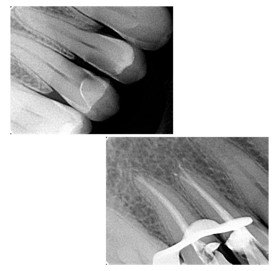 tratamiento de endodoncia CSDental