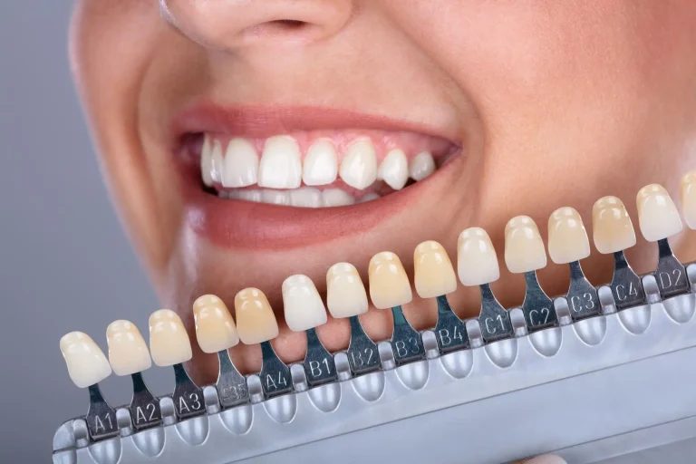 tipos de carillas dentales
