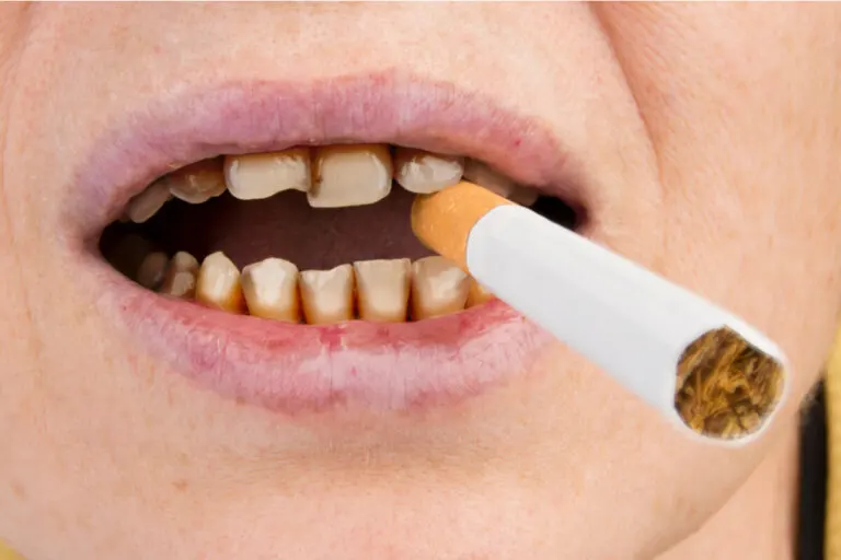 Cómo afecta el tabaco a los dientes