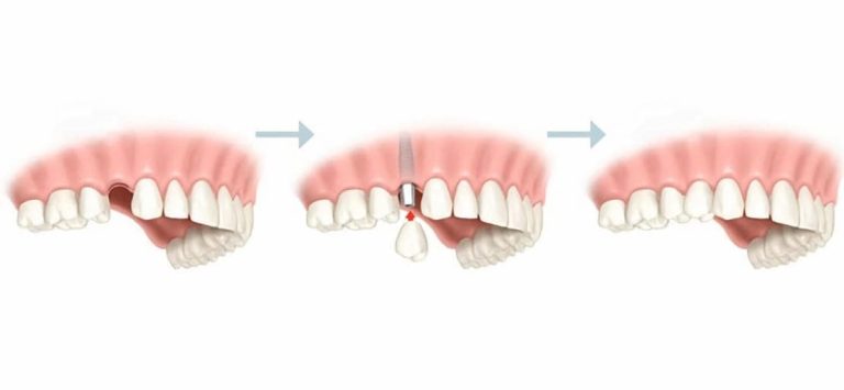 Cuánto dura un implante dental