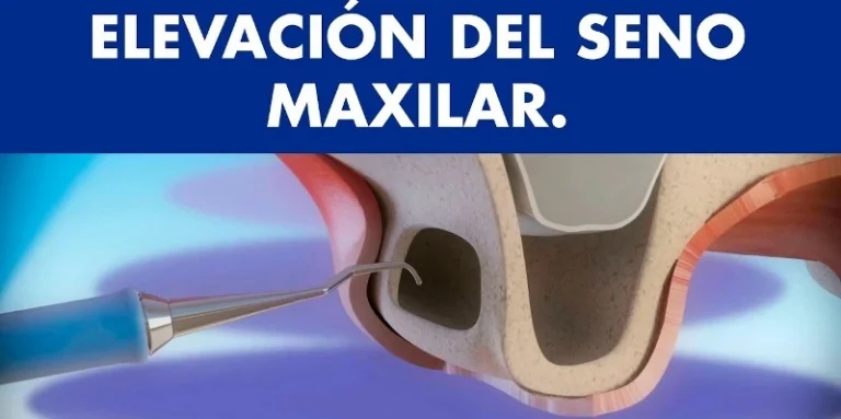 Elevación de seno maxilar