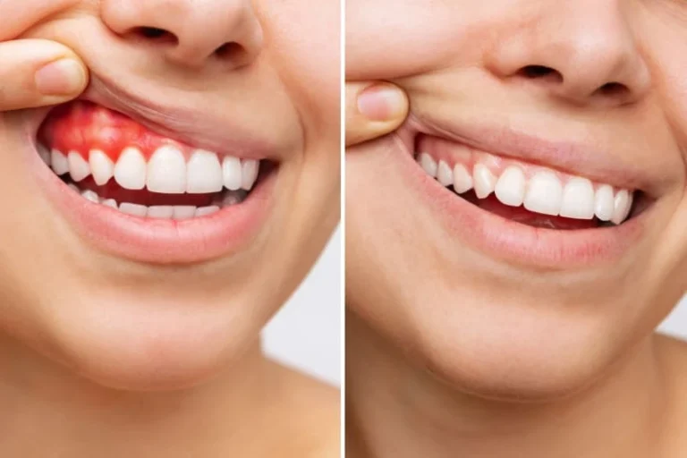 Gingivectomía