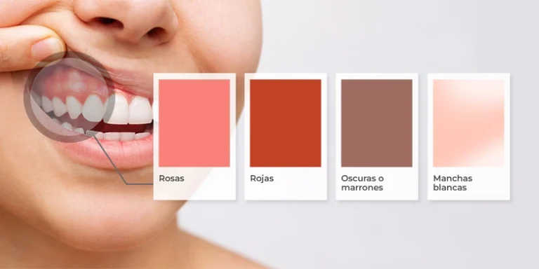 De qué color son las encías sanas