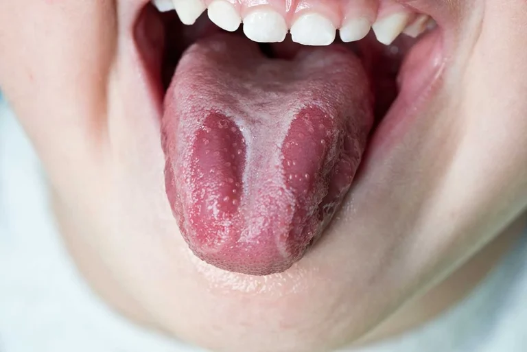 Lengua geográfica tratamiento