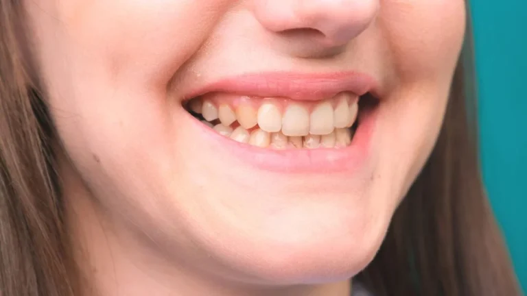 Fluorosis dental