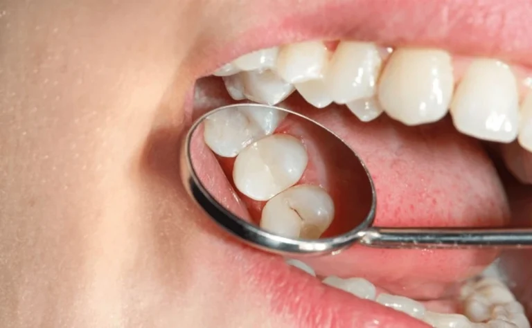 Cómo saber si tengo una caries