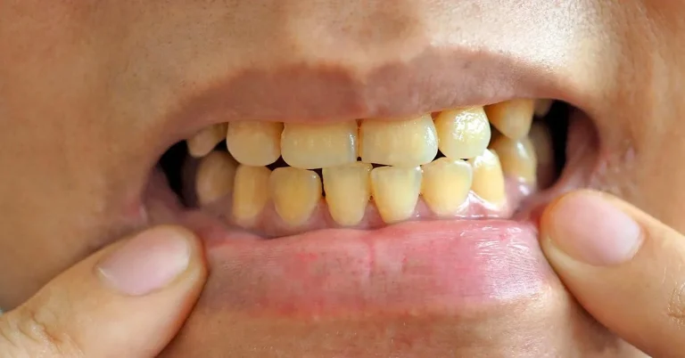 Dientes amarillos