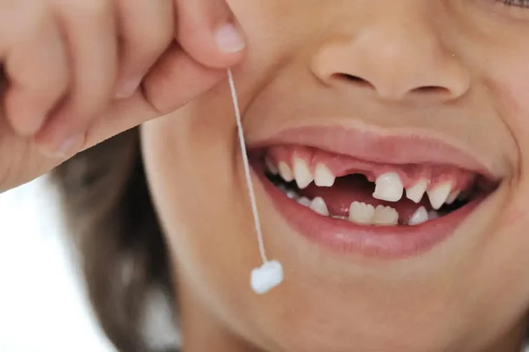 Cómo quitar un diente de leche sin dolor