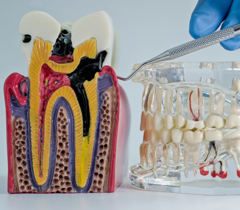 beneficios de tratamiento de endodoncia en madrid