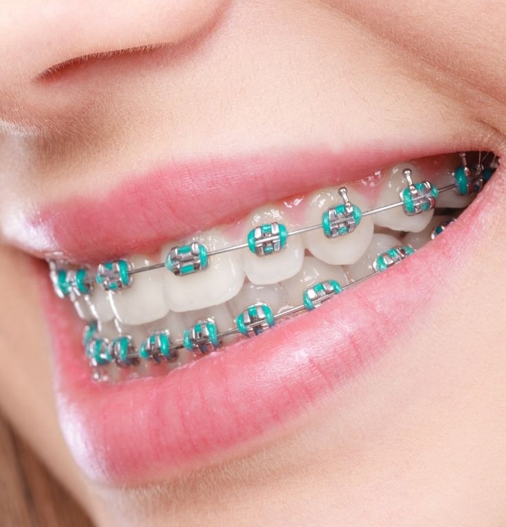 beneficios de los brackets odontologicos