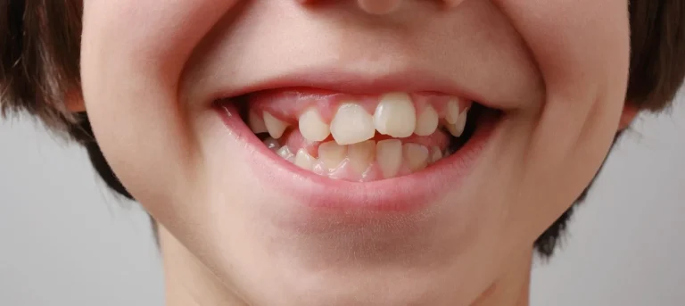 Dientes torcidos en niños