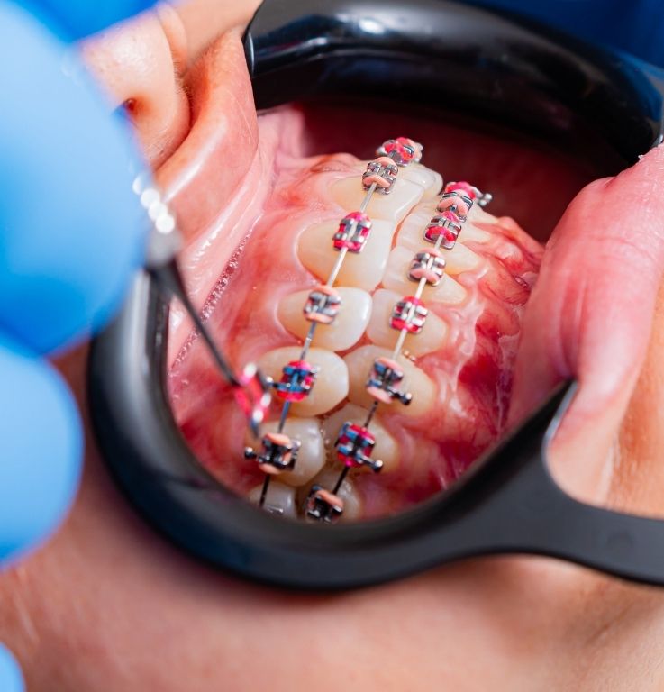 brackets en madrid