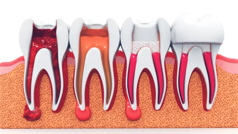 Cómo se realiza una endodoncia